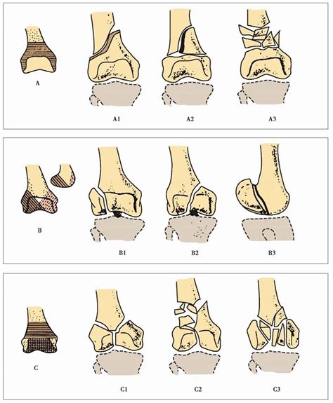 The Ao Classification Of Distal Femoral Fractures Medical And News