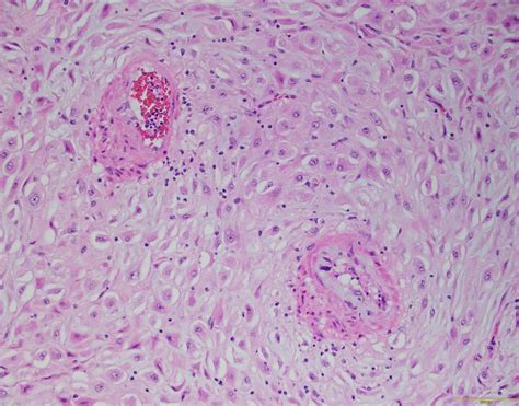 Qiaos Pathology Decidual Vasculopathy A Photo On Flickriver