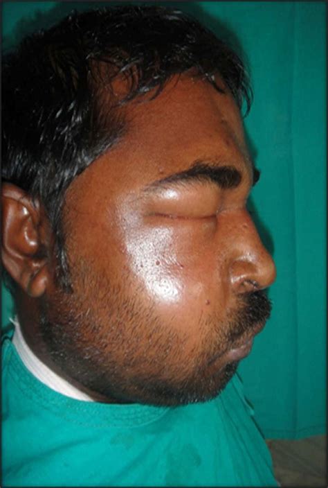 Photograph Showing Patient With Buccal Space Abscess Canine