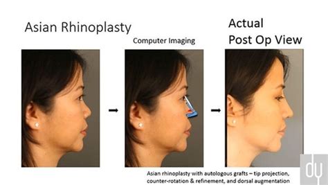 Asian Rhinoplasty Understanding Autologous Cartilages Roles Advant