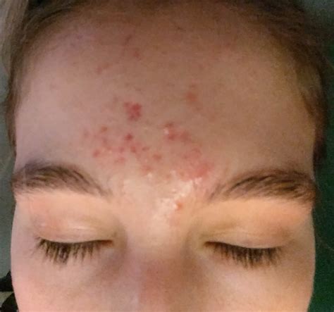 Neverending Forehead Breakout Picture General Acne Discussion