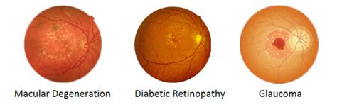 Oct And Retinal Digital Imaging Feltham Eyecare Centre