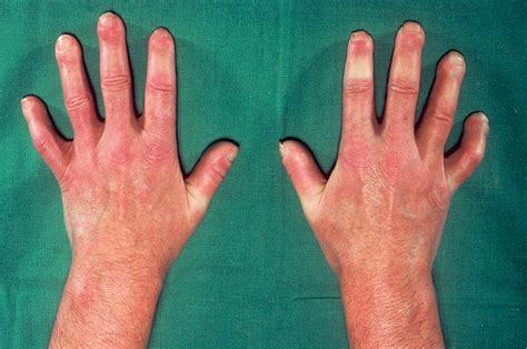 Systemic Sclerosis Medical Blog