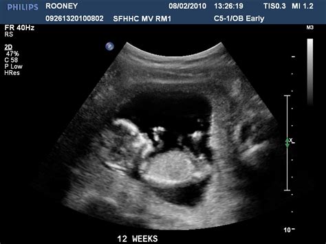 pregnancy ultrasound pictures 12 weeks
