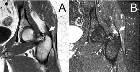 Figure 3 From Endoscopic Treatment Of Greater Trochanteric Pain