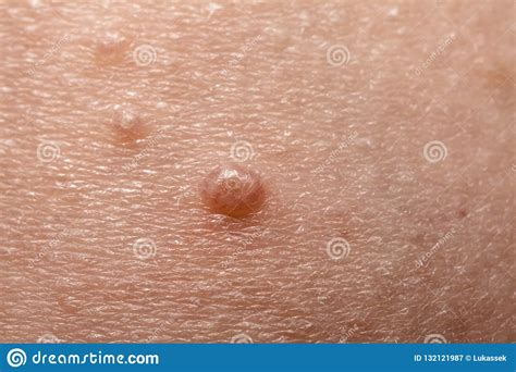 Close Up Of Molluscum Contagiosum Also Called Water Wart Stock Image