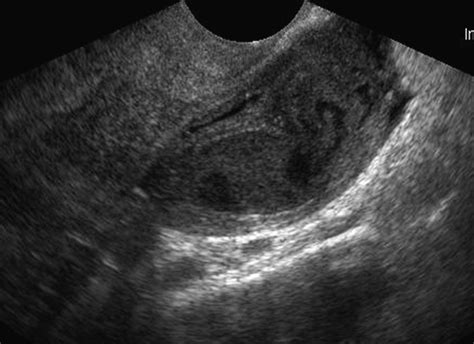 Acute Pelvic Inflammatory Disease Patient Presented With Left Lower