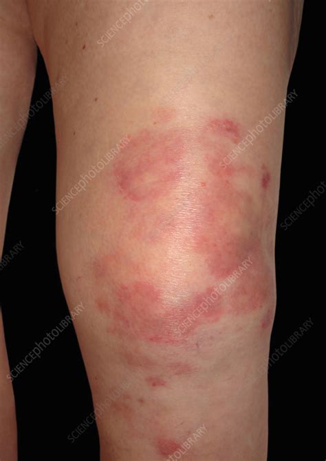 Ringworm Fungal Infection Stock Image C0473505 Science Photo Library