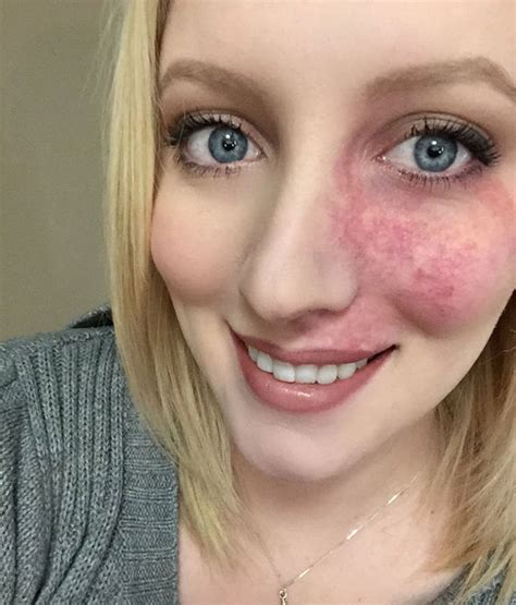 Girl With Birthmark Shows Her Face After Finding Love Life Life And Style Uk