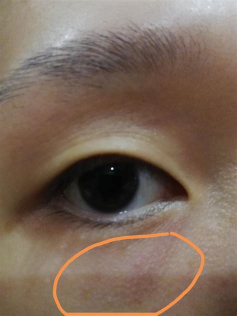 Weird Bumps Around My Lower Eye Area Help Rskincareaddicts