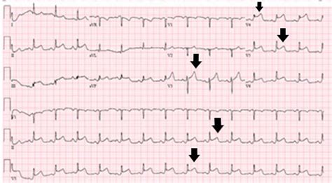 Ecg With St Elevation Myocardial Infarction Stemi In The