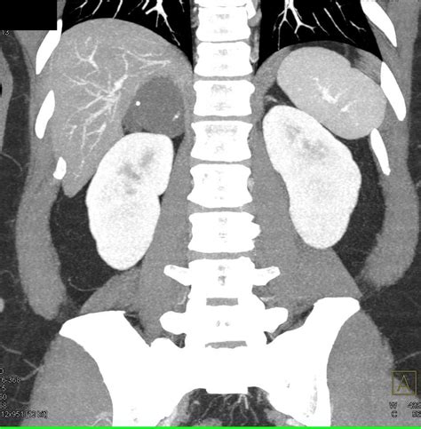Right Adrenal Lymphangioma Adrenal Case Studies Ctisus Ct Scanning