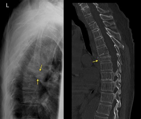 Thoracic Spine Fracture Radiology At St Vincents University Hospital