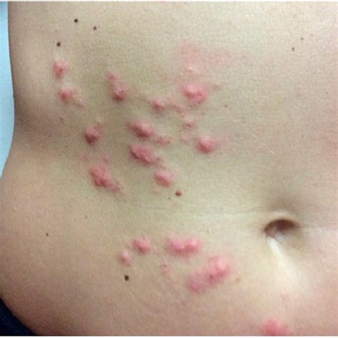 Resolution Of The Right Anterior Abdominal Wall Follicular Rash This