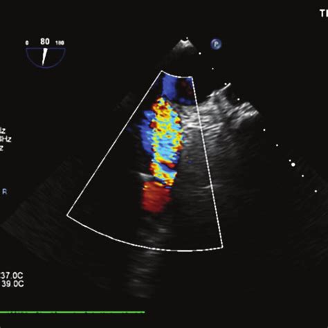 Prosthetic Pulmonary Valve Stenosis Following Surgical Replacement On