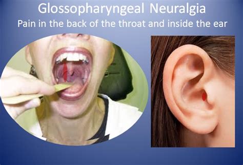 Glossopharyngeal Neuralgia