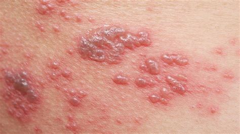Antiviral Use Declines As Shingles Vaccine Protects Elderly From