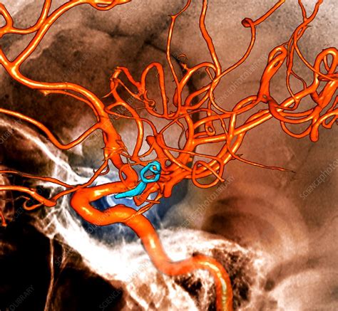 Brain Aneurysm Shown Explained Using A 3d Medical Ani