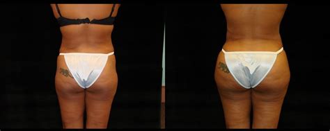 Main aim is to give the buttocks a lift and a new shape that suits the body proportion of the patient. Patient #759 Brazilian Butt Lift Before and After Photos ...