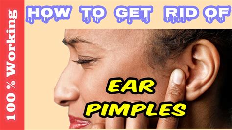 How To Get Rid Of Pimples On Ear Overnight Fast Home Remedies