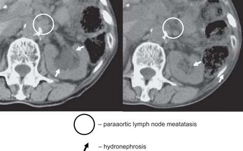Lymph Node Metastasis And Hydronephrosis Left Figure Shows Paraaortic
