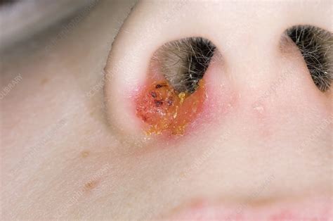 Impetigo On The Nostril Of A Child Stock Image C0033001 Science