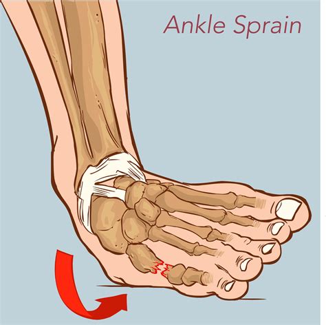 Treating A Sprained Ankle