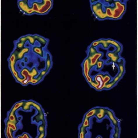 Diaschisis In Patient With Basal Ganglia Hematoma A Initialct Shows