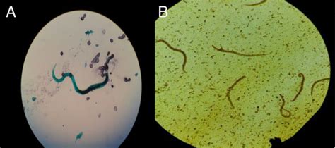 Strongyloides Hyperinfection Syndrome And Vre Pneumonia Bmj Case Reports