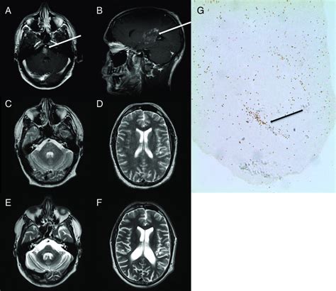 A Coronal Gadolinium Contrast Enhanced T1 Weighted Mri Reveals A Lesion