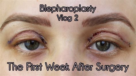 My Eyelid Surgery 1st Weeks Of Recovery Cosmetic Blepharoplasty Diary