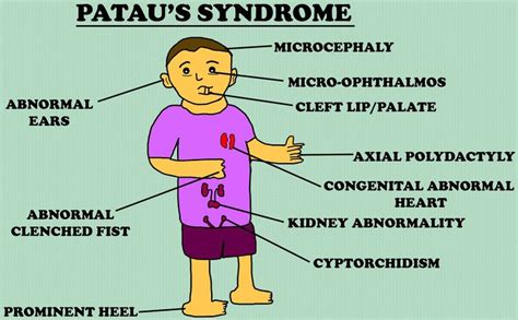 Pataus Syndrome Medizzy