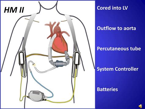 Ppt Heartmate Ii Left Ventricular Assist Device Lvad Powerpoint