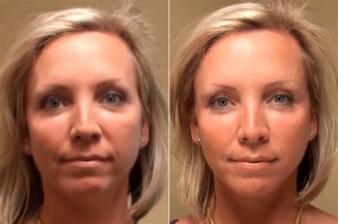 Cosmetic Injectables Photos Cincinnati Facial Plastic Surgery