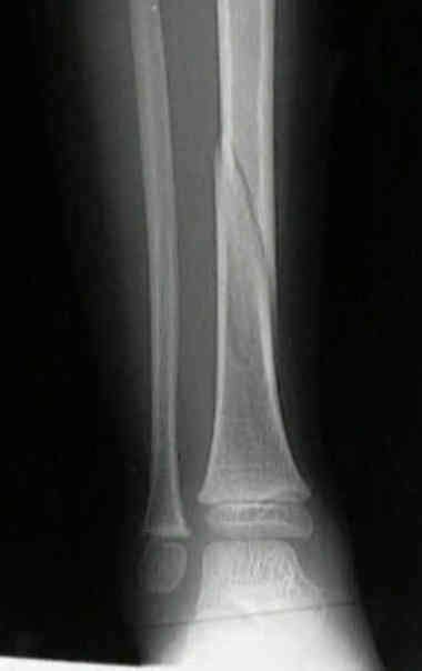 Pediatric Tibial Fracture Wheeless Textbook Of Orthopaedics