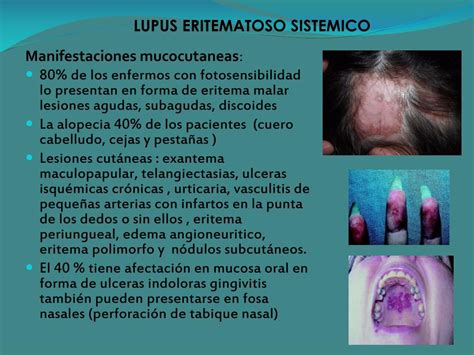 Ppt Lupus Eritematoso Sistémico Powerpoint Presentation Free