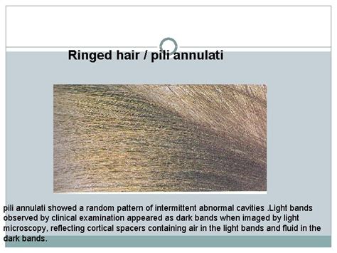 Hair Shaft Disorders Giti Sadeghian Dermatologist Skin Diseases