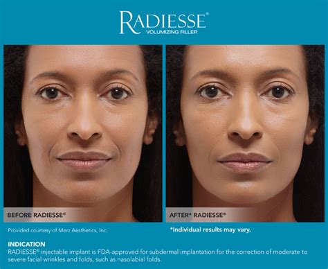 Radiesse In New Jersey Soma Skin And Laser