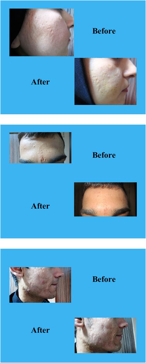 Introduction Of A Novel Therapeutic Option For Atrophic Acne Scars