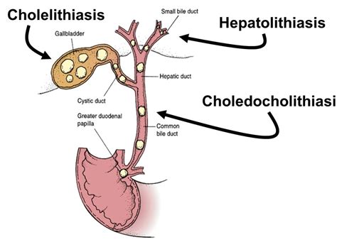 Choledocholithiasis Stepwards