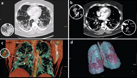 Abrupt Deterioration And Pulmonary Embolism In Covid 19 A Case Report