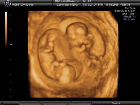 Embarazo Ultrasonido 3d Y 4d ¿qué Tan útiles Son