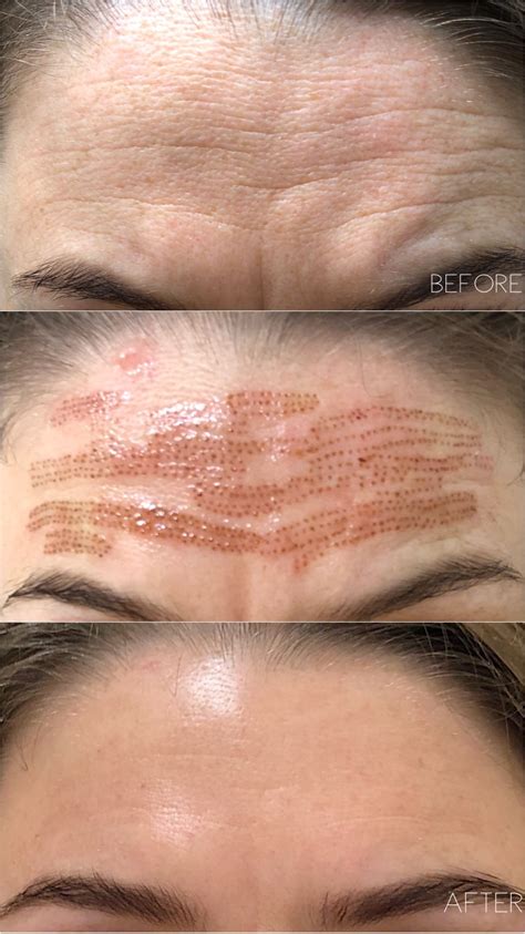 Plasma Skin Treatment Before And After Your Magazine Lite