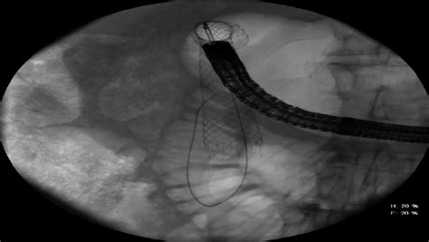 Choledochoscope With Stent Placement For Treatment Of Benign Duodenal