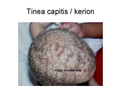 Common Pediatrics Rashes Primary Skin Lesions Primary Skin