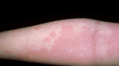 Anaphylaxis Rash Urticaria Hives Allergy Anaphylaxis Australia