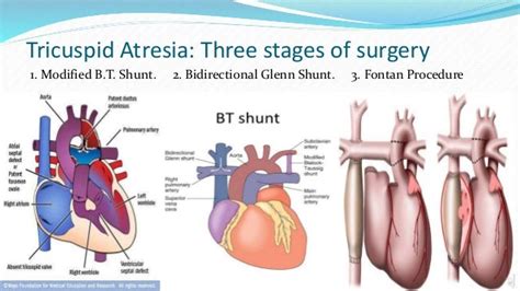 Congenital Heart Disease And Surgical Management