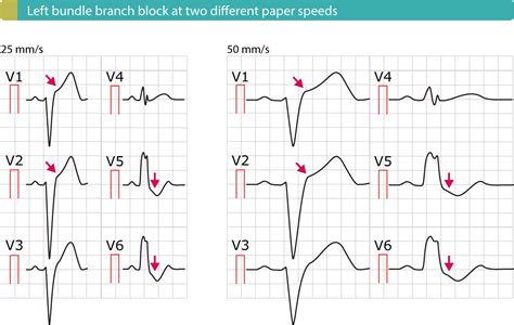 Figure 4 Left Bundle Branch Block Lbbb With Typical St Elevations