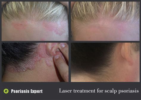 Laser Treatment For Scalp Psoriasis Psoriasis Expert