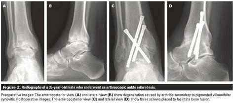 What Role Does Ankle Replacement Play In Managing Pain And Disability